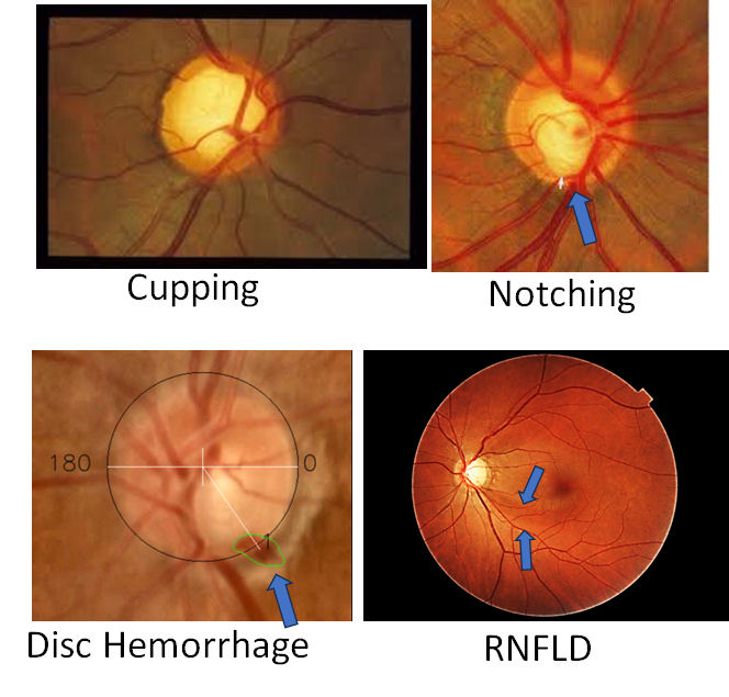Examples of glaucoma-related findings visible in fundus photographs including cupping, rim notching, disc hemorrhage and retinal nerve fiber layer defects.