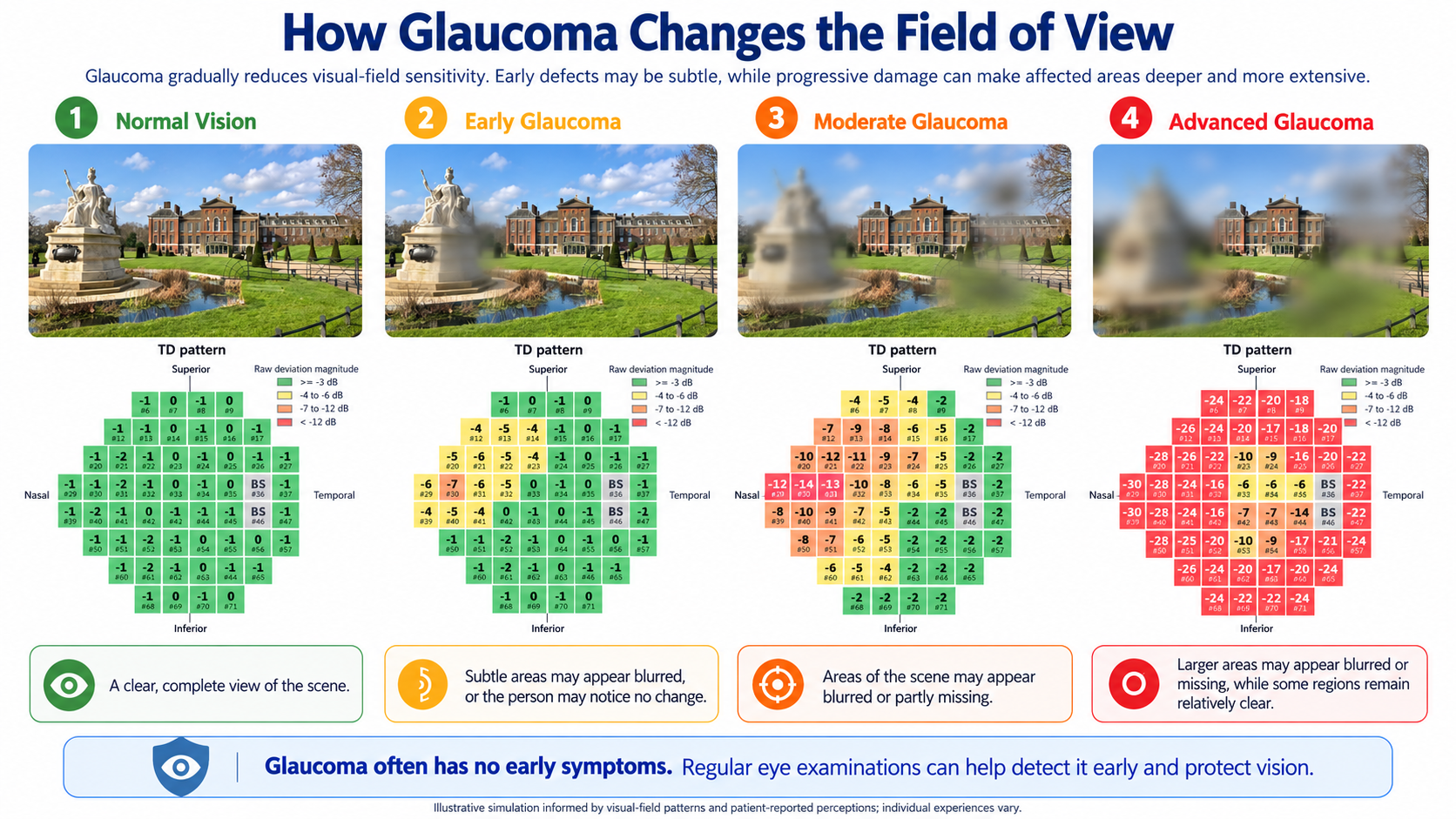 Conceptual illustration showing a wide normal field of view progressively narrowing in early, moderate and advanced glaucoma.